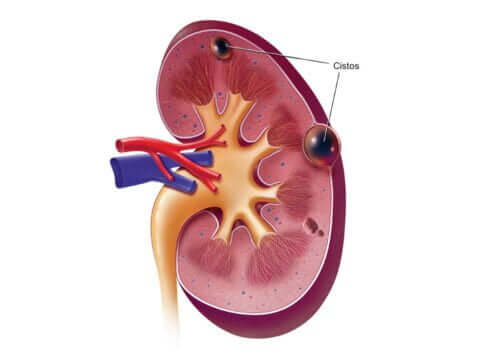 Desenho de um rim direito contendo 2 cistos renais
