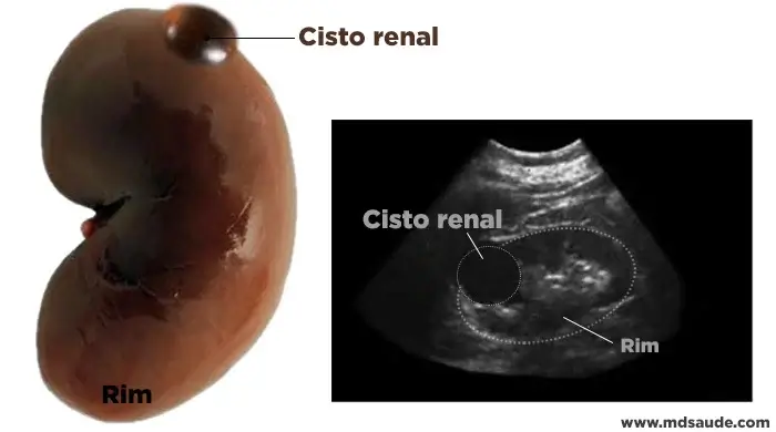 Aparência de um cisto renal - no órgão e na ultrassonografia