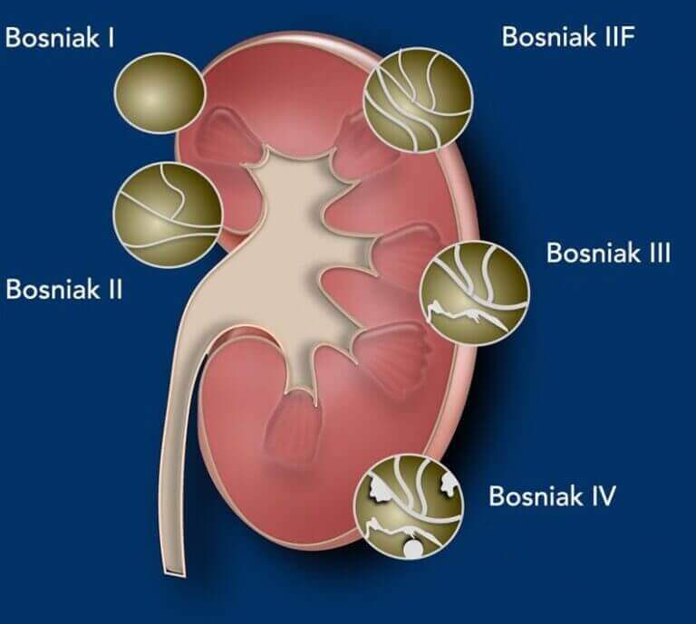 Foto mostrando os diferentes tipos de cisto renal, de acordo com a classificação de Bosniak